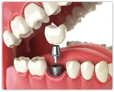 illustration of a dental implant