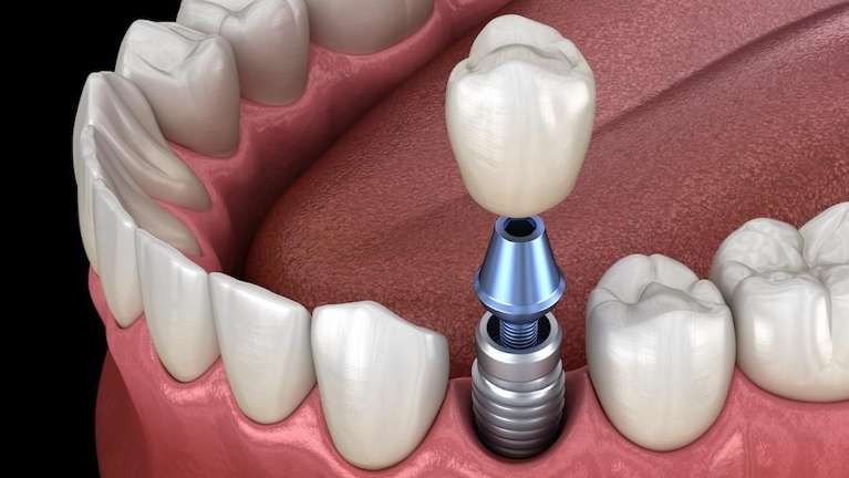 dental implants, dentures, tooth replacement, Fredericksburg dentist, North River Dental Care, Dr. R