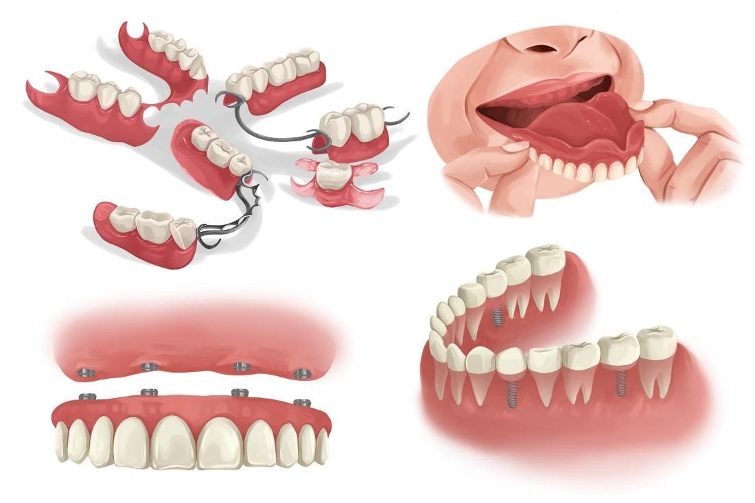 Are Dentures Right for Me? Dentures Fredericksburg VA